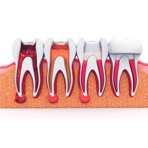 Endodoncia en Galvez_Explicación del proceso de infección y como salvar el diente