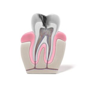 Proceso de Endodoncia:Clínica Dental Ortiz en Gálvez